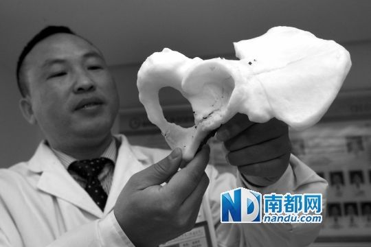 3D打印首次应用于广州临床治疗：医生3D打印新骨头